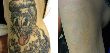 Tattoo Removal in Chandigarh