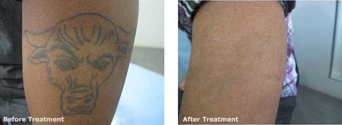 Know More About – Is It Painful to Remove Tattoo?