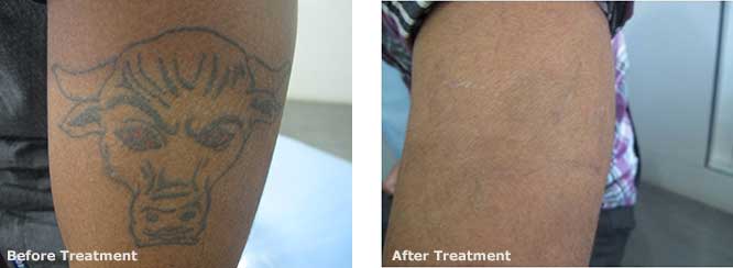 North Colorado's Newest Laser Tattoo Removal | LaserAll