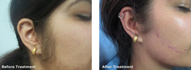 Laser hair reduction (Side locks and Jawline)