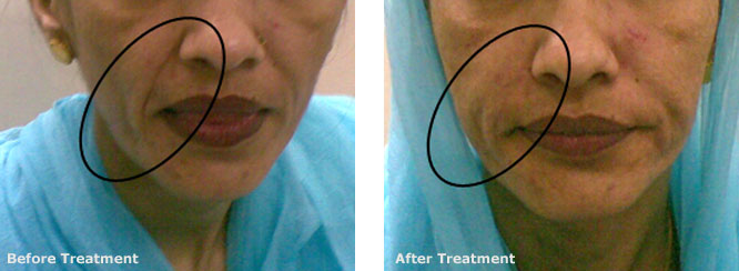 Filler Nasolabial Folds and Accordian Lines
