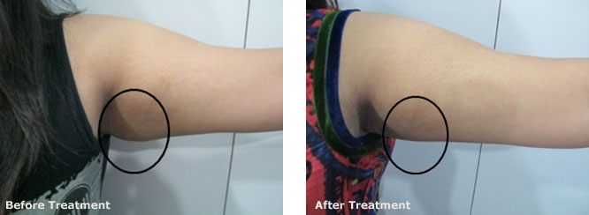 Lipolytic Mesotherapy for Spot Fat Reduction