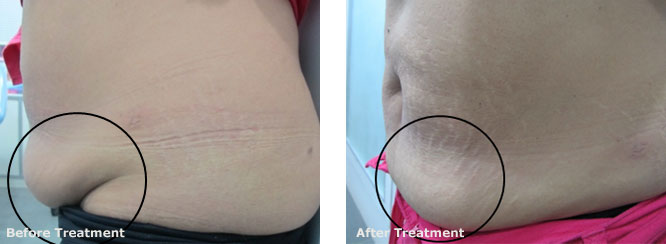 Lipolytic Mesotherapy for Spot Fat Reduction 2