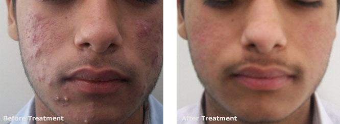 Active Acne And Post Acne Scars 3