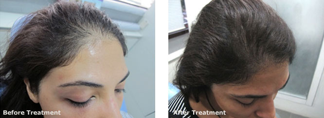 Mesotherapy for Hair Regrowth