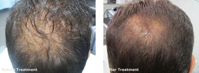 Mesotherapy for Hair Regrowth 2