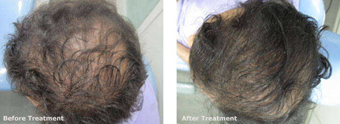 Mesotherapy for Hair Regrowth 3