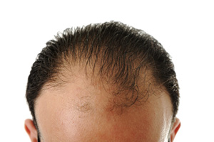 HAIR LOSS – Causes, Prevention and Treatment Options