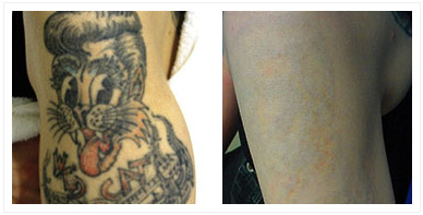 TATTOO and BIRTHMARK removal – It was never that easy!