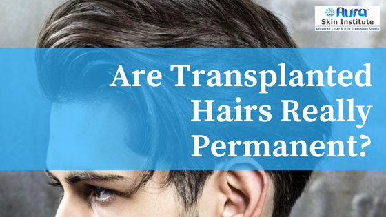 Are transplanted hairs really permanent?