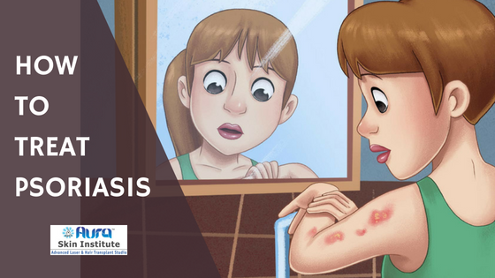 How to Treat Psoriasis