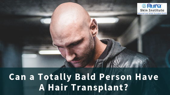 Can a Totally Bald Person Have A Hair Transplant?