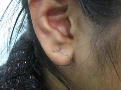 Earlobe Repair without Stitches  Earlobe repair at Aura Skin