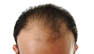 Hair loss in Man