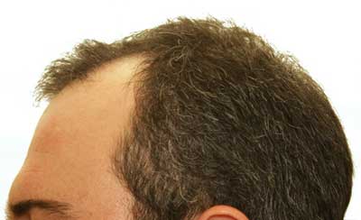 A photo of a man with V shaped Male Pattern Baldness