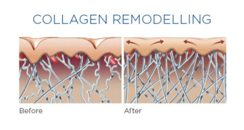 Collagen Remodelling