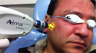 iPixel Laser Treatments