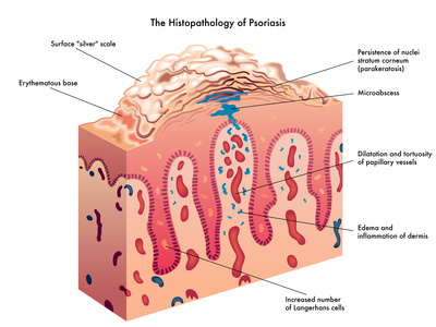 Psoriasis