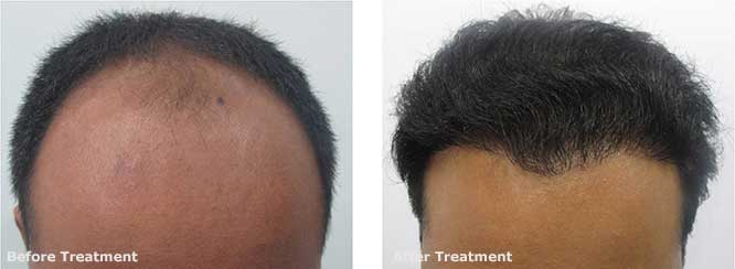 Hair Transplant in male pattern baldness