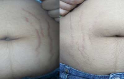 Stretch Marks Removal