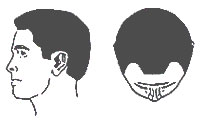 Hair-Loss Male-Pattern Type 1