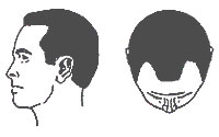 Hair-Loss Male-Pattern Type 2