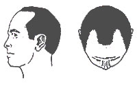 Hair-Loss Male-Pattern Type 3
