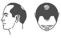 Hair-Loss Male-Pattern Type 3 Vertex