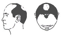 Hair-Loss Male-Pattern Type 4