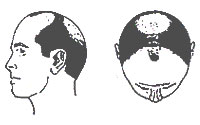 Hair-Loss Male-Pattern Type 5