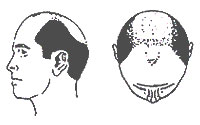 Hair-Loss Male-Pattern Type 6