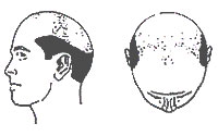 Hair-Loss Male-Pattern Type 7